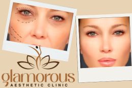 before and After Result Cosmetic Injectables in Riyadh Saudia KSA