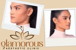 before and After Result Cosmetic Injectables in Riyadh Saudia Arabia