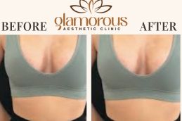 breast inlargement Before and After KSA
