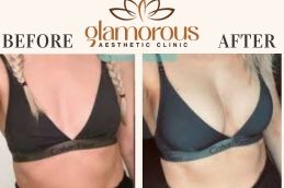 breast inlargement Before and After KSA result