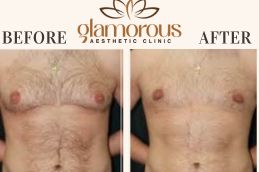 male Before and After Gynecomastia 