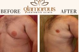 male Before and After Gynecomastia