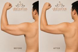 Arm lift surgery in Riyadh and saudia