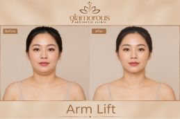 Before and After Arm Lift Riyadh