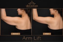 Before and After Arm Lift in Riyadh and jiddah