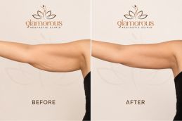 Before and After Arm Lift in Riyadh