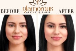 Before and After Cosmetic Surgery in Riyadh Saudia