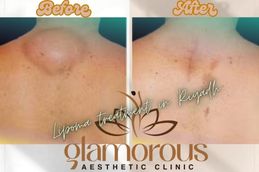 Before and After Lipoma treatment in Riyadh