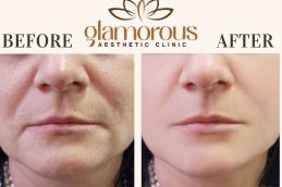 Before and After Result Cosmetic Surgery in Riyadh KSA