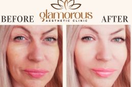Before and After Result Cosmetic Surgery in Riyadh Saudia Arabia
