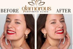 Before and After Result of Dermatologist Riyadh KSA