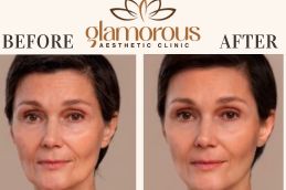 Before and After Result of Dermatologist in Riyadh