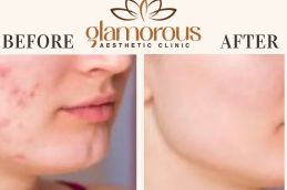 Before and After Result of Skin care in Riyadh Saudia (1)