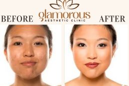 Before and After Result of Skin care in Riyadh Saudia