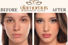 Before and After Result of Skin care in Riyadh