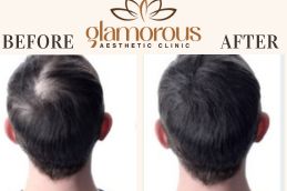 Before and After Result of Trichologists Riyadh KSA