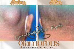 Before and After Result of lipoma treatment in Reyadh