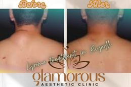 Before and After Results of Lipoma treatment in Riyadh & Saudia