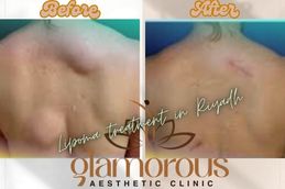 Before and After Results of Lipoma treatment in Riyadh