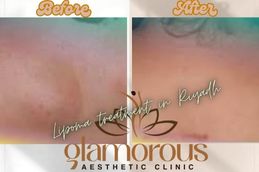 Before and After Results of Lipoma treatment results
