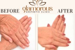 Before and After Skin care in Riyadh