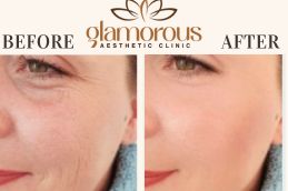 Before and After Skin care treatment Riyadh