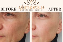 Before and After Skin care treatment in Riyadh