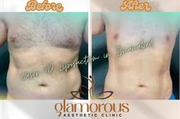 Before and After Vaser 4D liposuction in Islamabad &Pakistan