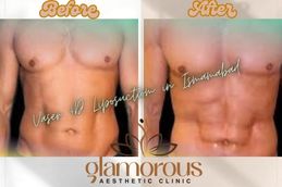 Before and After Vaser 4D liposuction in Islamabad & Pakistan