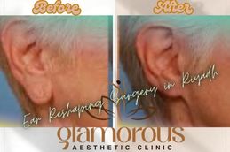 Before and After result Ear Reshaping surgery in Riyadh Jiddah & KSA