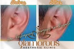 Before and After result Ear Reshaping surgery in Riyadh Jiddah & Saudia Arabia