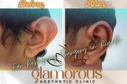 Before and After result Ear Reshaping surgery in Riyadh Saudia