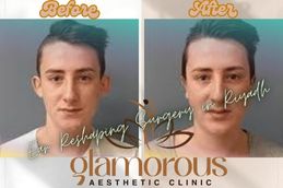 Before and After result Ear Reshaping surgery in Riyadh and Saudia Arabia 