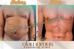 Before and After result Vaser 4D liposuction in Islamabad &Pakistan