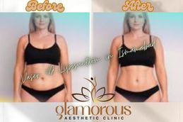 Before and After result Vaser 4D liposuction in Islamabad Rawalpindi &Pakistan