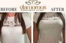Before and After result breast Surgery