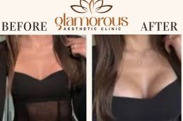 Before and After result breast Surgery Riyadh KSA