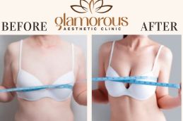 Before and After result breast Surgery Riyadh Saudia