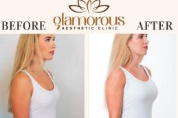 Before and After result breast surgery