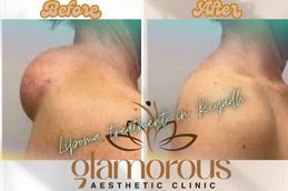 Before and After result of Lipoma treatment in Riyadh & Saudia Arabia