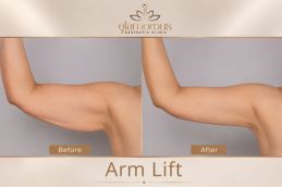 Before and After result of arm lift surgery