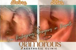 Before and After results Ear Reshaping surgery in Riyadh Jiddah & Saudia Arabia