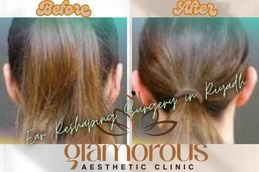 Before and After results Ear Reshaping surgery in Riyadh and Saudia Arabia