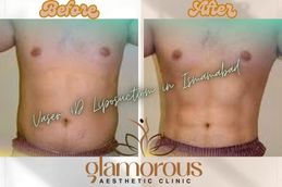 Before and After results Vaser 4D liposuction in Islamabad ,Rawalpindi &Pakistan
