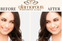Before and After results dermatologists in Riyadh 