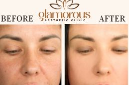 Before and After results dermatologists in Riyadh Saudia