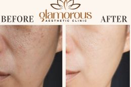 Before and After results dermatologists in Riyadh