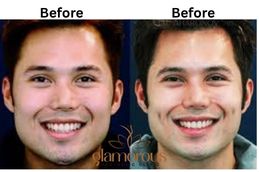Before and after Dimple creation result in Riyadh
