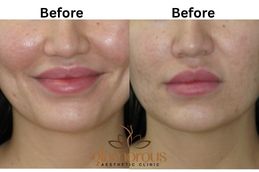 Before and after Dimple creation result in Riyadh , KSA