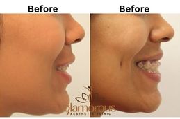 Before and after Dimple creation result in Riyadh ,Saudi Arab